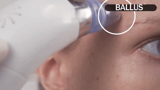 Nestora Pore Cleaning Device – Blackhead Remover Vacuum Suction, Skin Care Tool