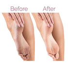 Nestora Electric Pedicure Foot File – USB Rechargeable Callus Remover, Heel Care
